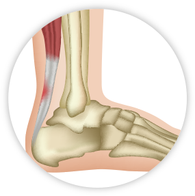 Aumento de la frecuencia de lesiones y fracturas en músculos, tendones y ligamentos