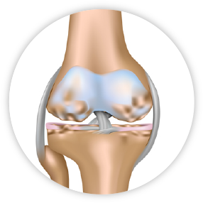 Tendencia a desarrollar enfermedades osteoarticulares degenerativas: osteoporosis, artrosis...